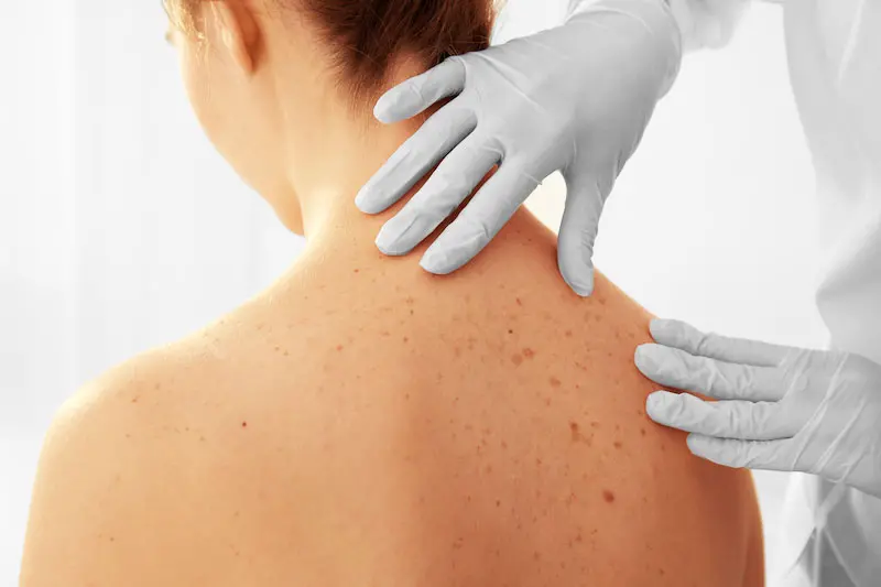 Melanoma, come fare prevenzione: la regola 'abcde' e quella del 'brutto anatroccolo'